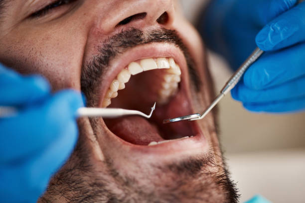 Best Emergency Tooth Extraction in Banner Hill, TN